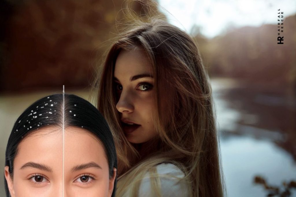 white flakes off their head, highlighting dandruff or dry scalp